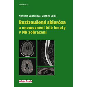 Roztroušená skleróza a onemocnění bílé hmoty v MR zobrazení | Manuela Vaněčková, Zdeněk Seidl